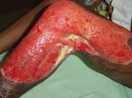 Buruli Ulcer